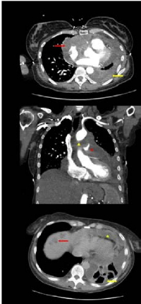 Figure 1: CT imaging of cardiac angiosarcoma prior to  propranolol treatment.  (A) 