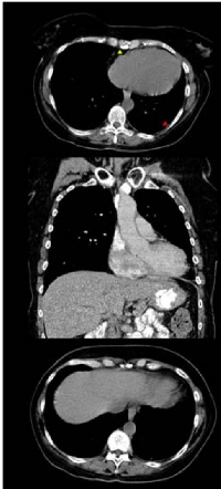 Figure 2:  CT imaging of cardiac angiosarcoma  subsequent to propranolol treatment.  (A) 