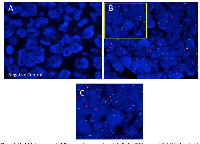 Figure 1: Her2 DNA expressed in RB tumors. 