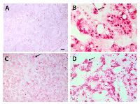 Figure 2:  Her2 RNA expressed in RB tumors. 