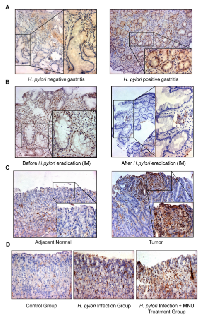 Figure 2:  pSTAT3 was increased in H. pylori -associated  clinical gastric tissues.