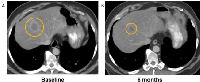 Figure 2:  Computerized tomography (CT)  demonstrating response to treatment with  combination cetuximab, erlotinib, and  bevacizumab in a patient with  