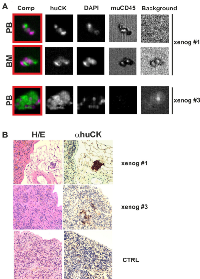 Figure 3: A) Human CTCs in peripheral blood (PB) and DTCs in bone marrow (BM) of xeno-transplanted mice. 