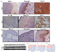 Figure 1: MDA-9/Syntenin expression pattern in HNSCC progression. 