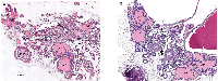 Figure 2:  Prostate histology (H&E) from 3month old wild type (A) and Id4 knockout (Id4-/-) mice. 