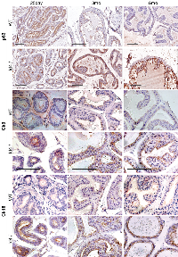 Figure 5:  Immuno-histochemical localization of p63 (top panel), Keratin 8 (Ck8, middle panel), and Keratin 18 (Ck18,  bottom panel) in Id4-/-  (Id4 knockout) and wt (wild type) prostates from 25d, 3m and 6m old mice. 