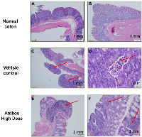 Figure 4: Anthos-treated <i>Apc</i><sup><i>Min</i>/+</sup> mice inoculated with ETBF featured fewer, more well differentiated tumors, with immune response.