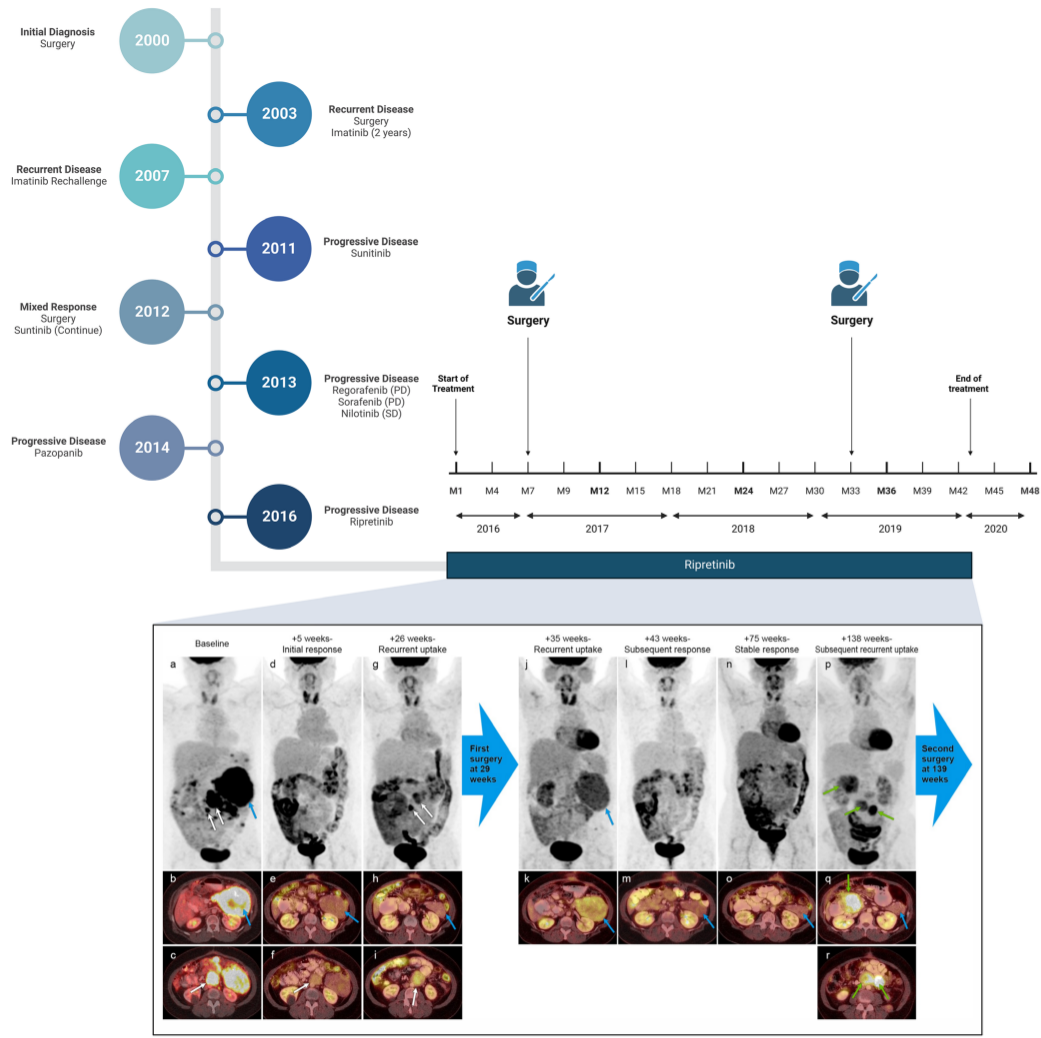 Oncoscience Multidisciplinary management of recurrent