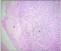 Figure 1: Pure Sertoli cell tumor in the right ovary (*) with adjacent ovarian tissue (Arrow) (4×).