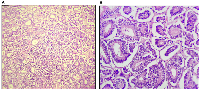 Figure 2: Tubules of tumor cells in Sertoli cell tumor (10×; 40×).