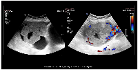 Figure 1: Transabdominal sonography image revealing a well-defined, predominantly solid-cystic lesion (10.2 × 7.8 × 7.8 cm) with vascularized solid components in the right adnexa with areas of hemorrhage.