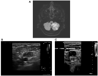 Figure 1: Multi-modality imaging findings in a patient with Trousseau’s syndrome and metastatic colorectal cancer.