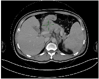 Figure 1: CT scan Abdomen axial view showing lesion within pancreas/adjacent peripancreatic lymphadenopathy.