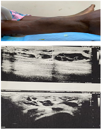 Figure 1: Swelling over anterior aspect of right leg; USG showing hypoechoic cystic lesion measuring 6.8 × 5 cm containing blood as content suggestive of an organised hematoma.