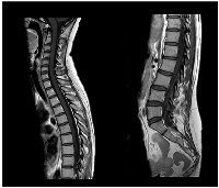 Figure 4: CE and neuraxis MRI response evaluation after 3 cycles of T-DXd.