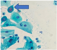 Figure 1: Pap smear shows cytoplasmic projection and nuclear smudging (Pap stain, 400×).