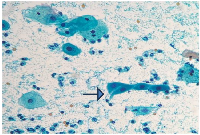 Figure 2: Smear shows cytoplasmic projection (Pap stain, 400×).