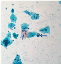 Figure 3: Smear shows a cell with cytoplasmic vacuolation (Pap stain, 400×).
