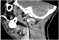 Figure 1: Sagittal CT imaging in cervicofacial necrotizing fasciitis.