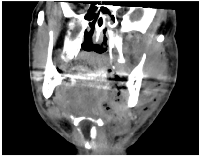 Figure 2: Contrast-enhanced CT scan demonstrating hallmark features of cervicofacial necrotizing fasciitis.