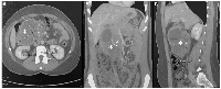 Figure 1: Contrast-enhanced abdominal CT of a large retroperitoneal mass. 