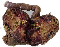 Figure 2:  Gross photograph of the duodenopancreatectomy specimen. 