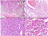 Figure 3:  Histopathological features of the solid pseudopapillary neoplasm. 