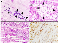 Figure 4:  Histopathological and immunohistochemical features of the solid pseudopapillary neoplasm. 