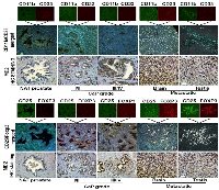 Figure 3:  Immunohistochemistry (IHC) and Immunofluorescence (IF) analysis of MD2 expression and immune cell  infiltration in prostate cancer tissues. 