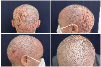 Figure 1: Painful, crusted erosive plaques confined to the irradiated scalp region in patient under amivantamb  treatment.