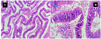 Figure 3:  Tumor histopathology. 